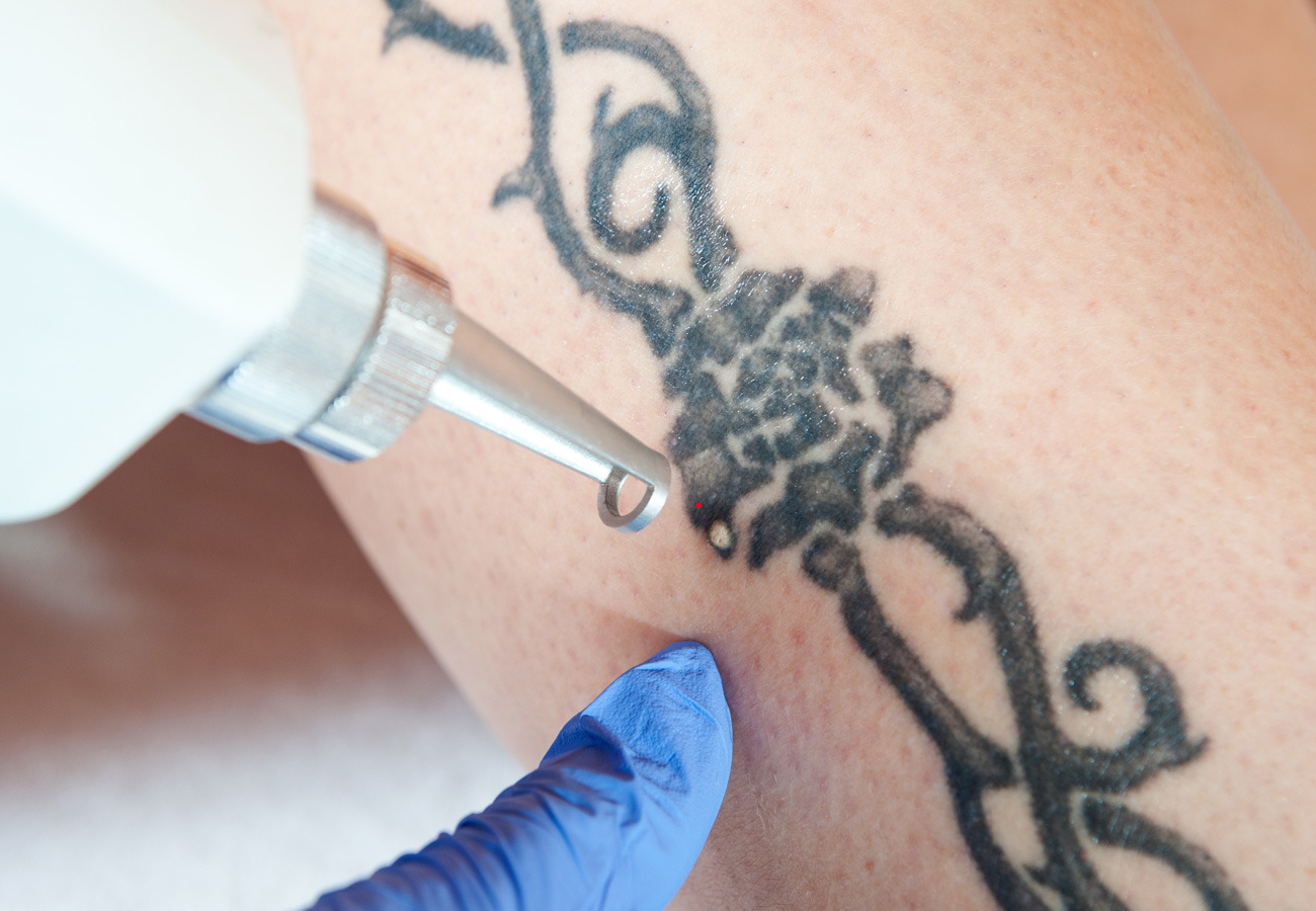 Tattoo Removal Myths Debunked